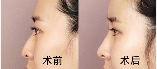假体隆鼻手术疼不疼