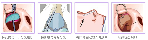 假体隆鼻手术过程是怎么样的