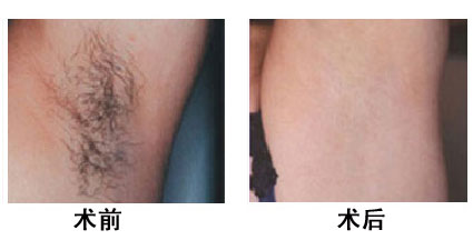冰点激光脱腋毛多少钱