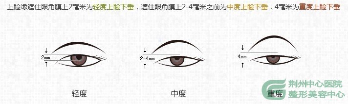 荆州上睑下垂上提术-让你年轻5岁的秘密