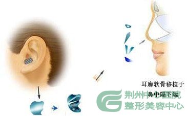 荆州自体组织隆鼻多少钱