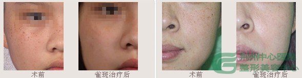 彩光祛斑副作用到底有哪些
