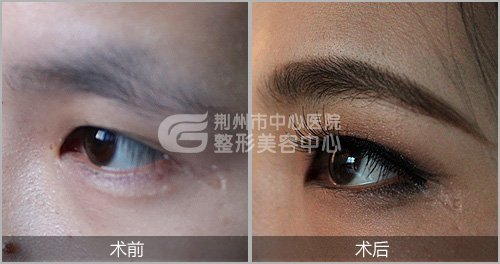 眉毛种植疼不疼呢