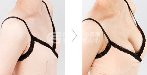 自体脂肪隆胸优缺点是什么