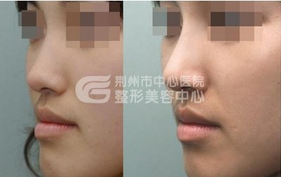 假体隆鼻会留疤吗