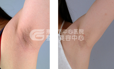 激光脱腋毛疼不疼