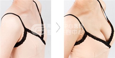 自体脂肪隆胸有缺点吗？