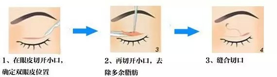图说双眼皮、开眼角 让你一分钟看懂眼部整形手